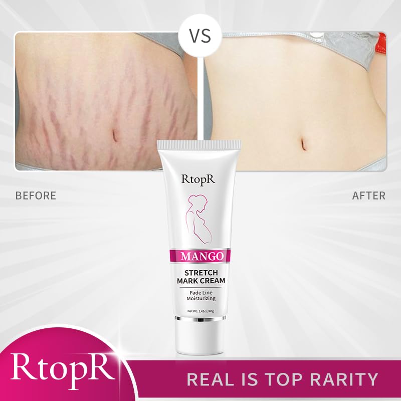 RtopR Mango Stretch Mark Cream for Pregnancy, Stretch Mark Repair Cream, Fade Line, Moisturizing and Non-Greasy, Safe to Use When Pregnant