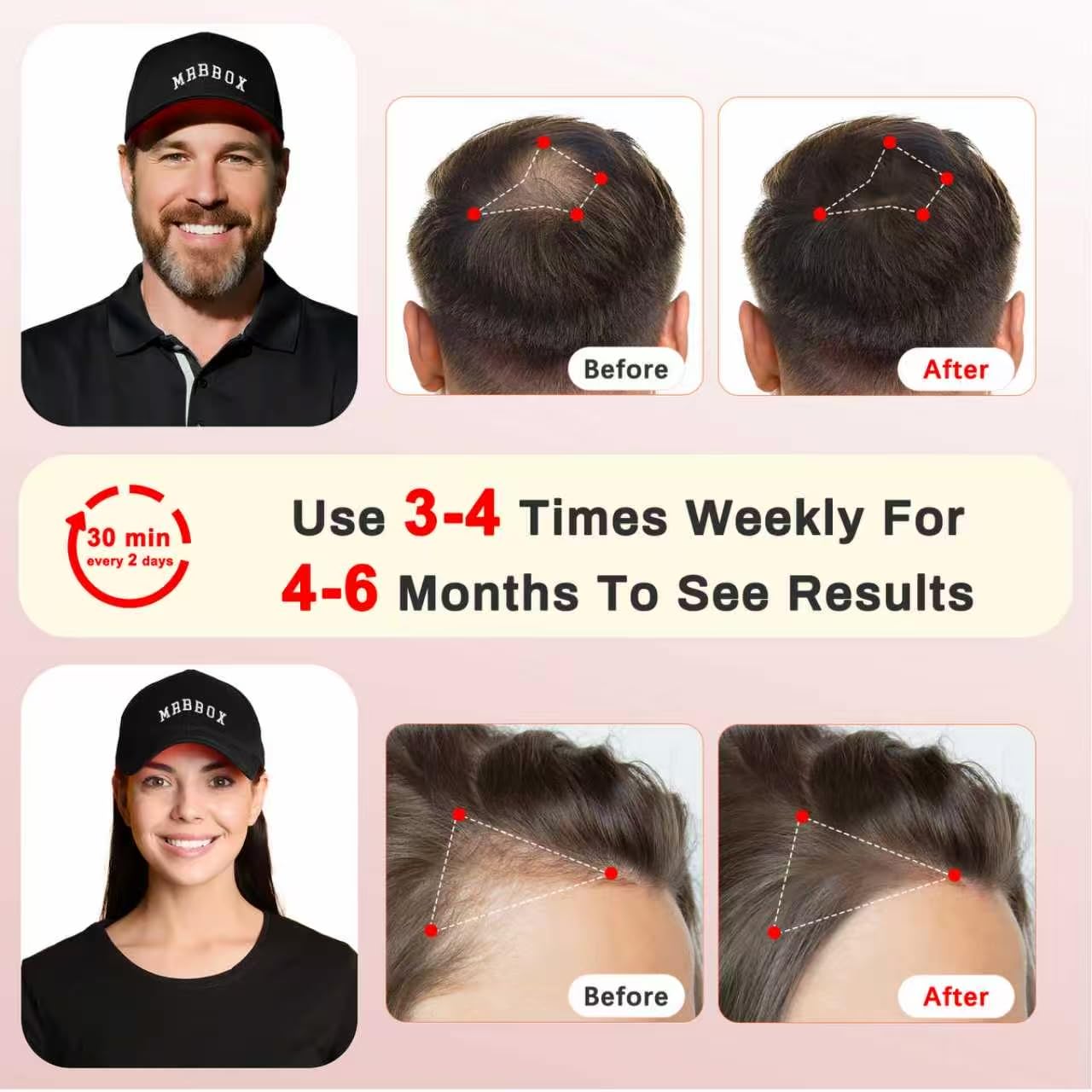 Laser Hair Growth Cap, Irradiation Aesthetic Device