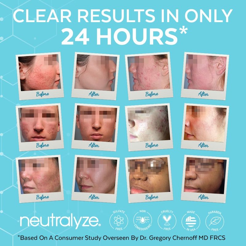 Neutralyze Moderate to Severe Acne Treatment Kit 2.0 - Maximum Strength 3 Step Acne Kit with 2% Salicylic Acid, 2% Mandelic Acid & Nitric Oxide - Includes Face Wash, Clearing Serum & Synergyzer
