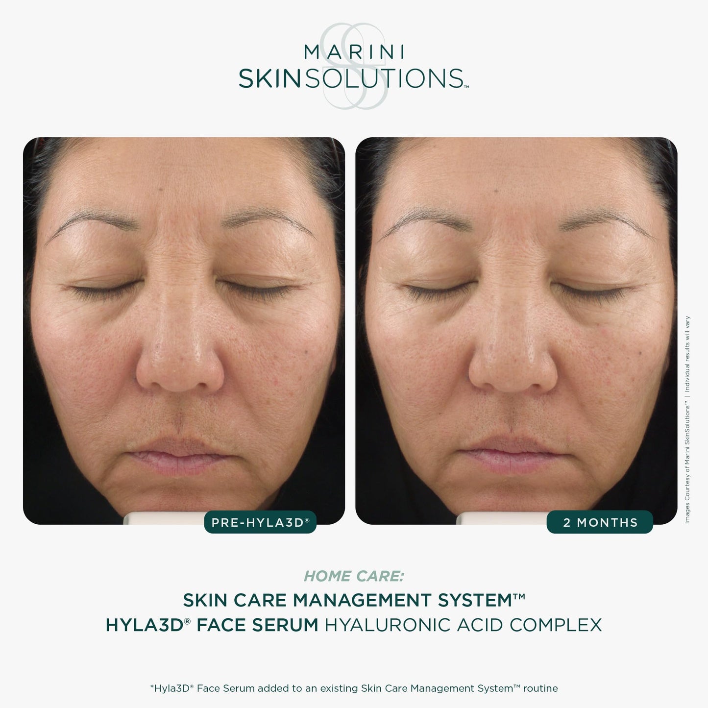 Marini SkinSolutions Hyla3D Face Serum - Patented Hyaluronic Acid Complex - Long-Lasting Skin Hydration - Good for Fine Lines, Wrinkles, Laxity, Volume - All Skin Types - Made in the USA - 1 fl oz