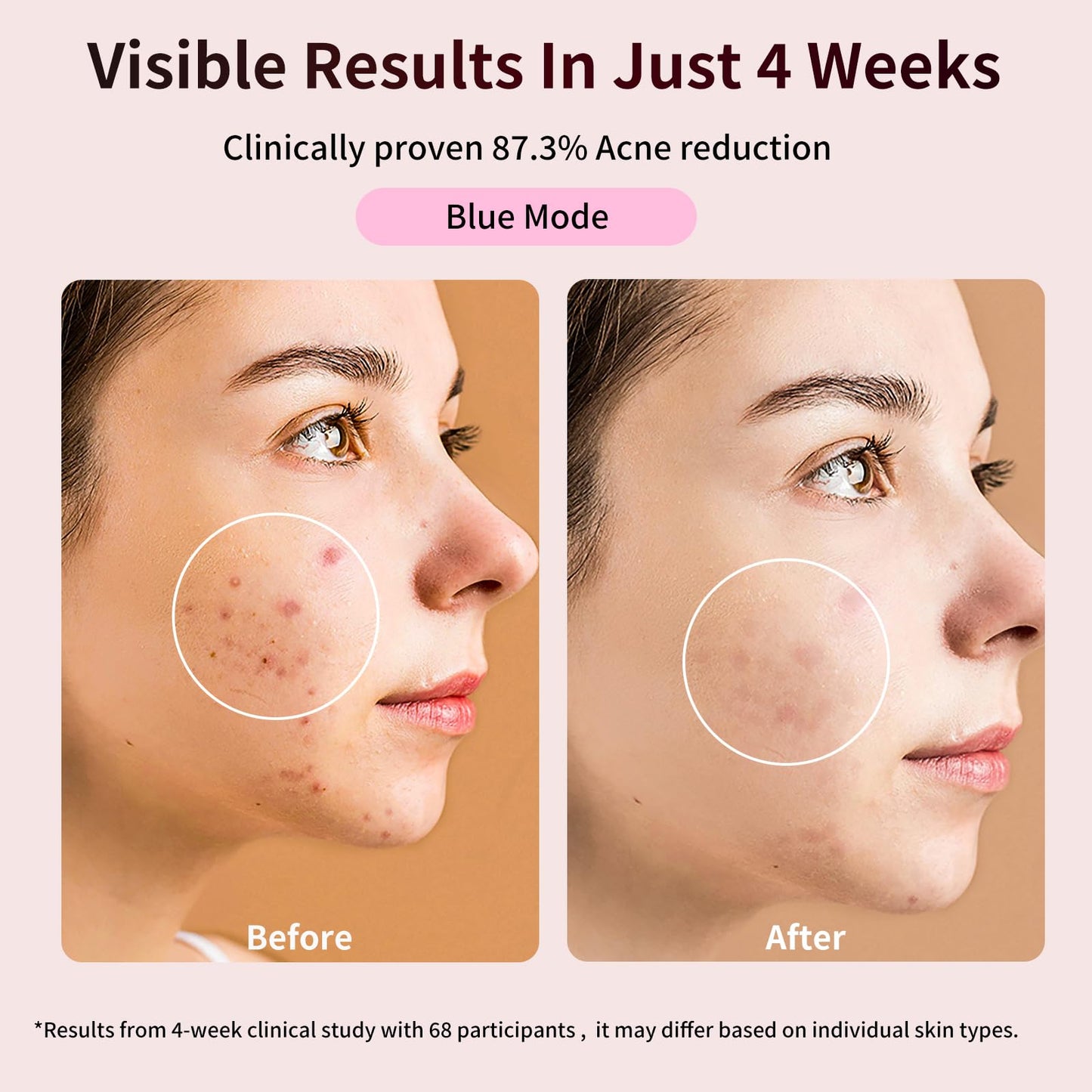TOFEKIA FDA-Cleared Red Light Therapy Mask for Face – 3 Modes for Acne and Wrinkles, 5 Intensity Levels，850nm Infrared Led Light Therapy Device, Pink