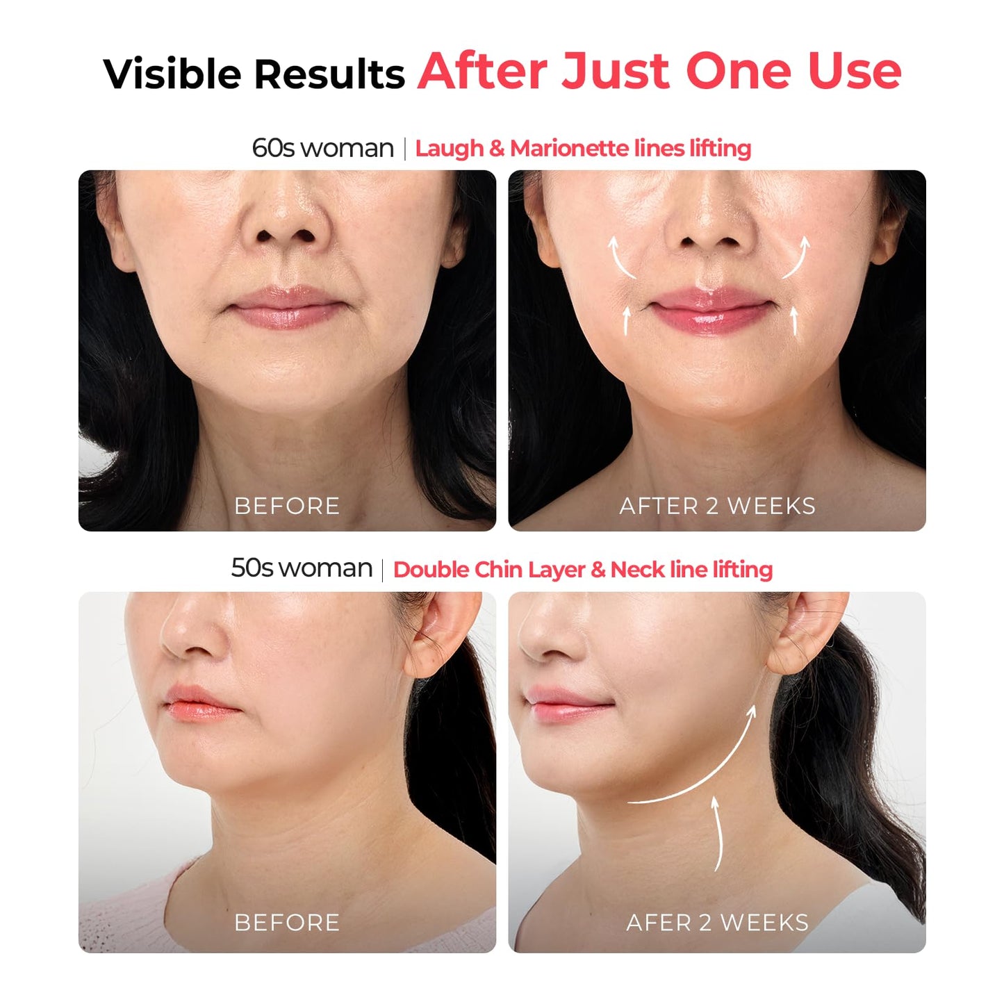 Aalok Ultra Olla | At-Home RF & LED Facial Device for Lifting, Anti-Aging Routine