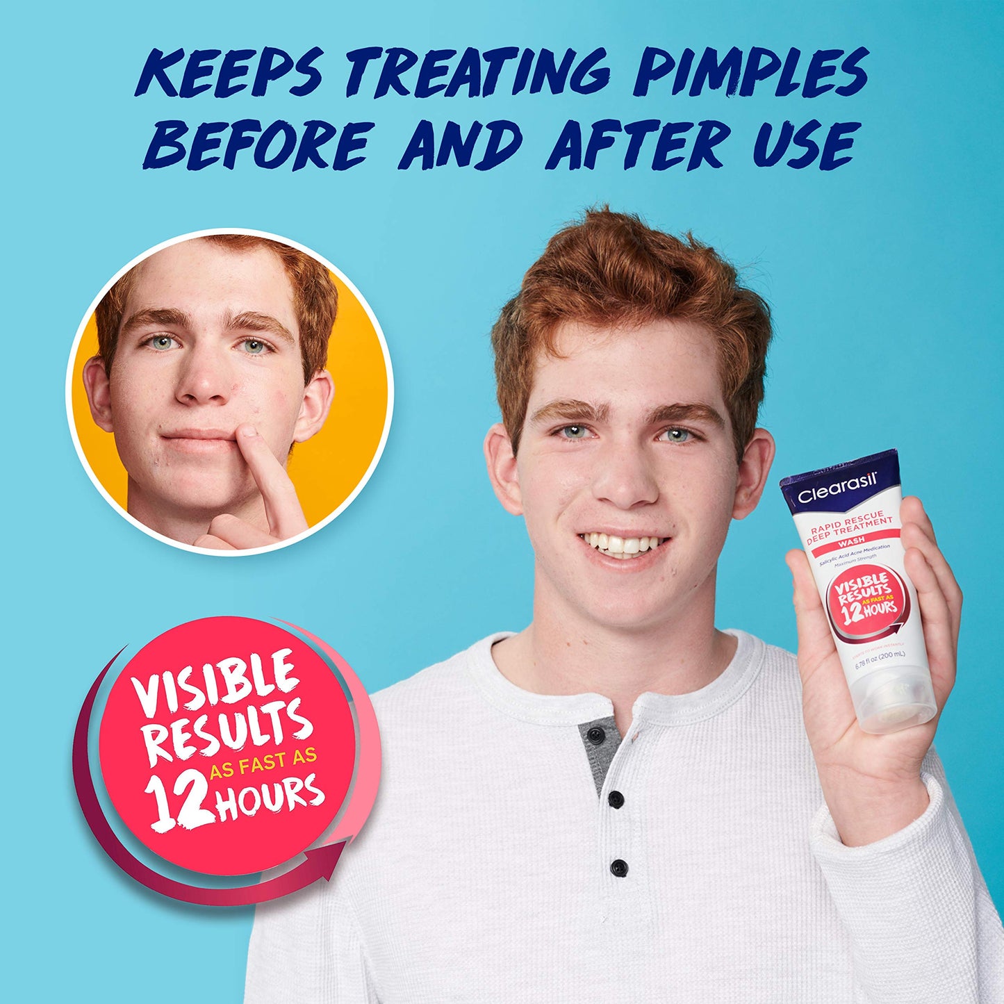 Clearasil Rapid Rescue Deep Treatment Acne Face Wash, Maximum Strenght with 2% Salicylic Acid Acne Medication, Acne-Facial Cleanser, 6.78 fl oz (Pack of 3)