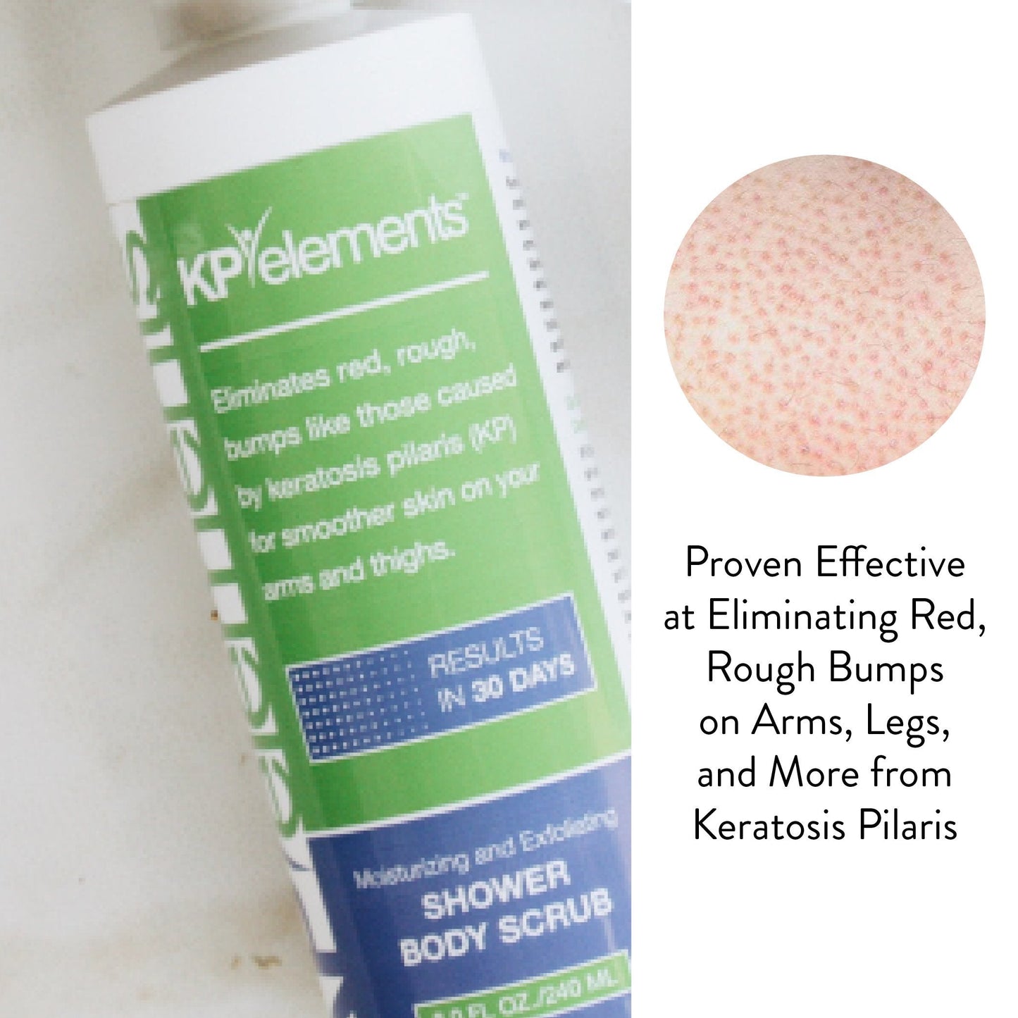KP Elements Body Scrub (8 fl oz) | Keratosis Pilaris Treatment | Exfoliating Body Scrub and Body Moisturizer for Dry Skin | Helps Reduce Red Bumps | Body Skin Care Product for Men and Women
