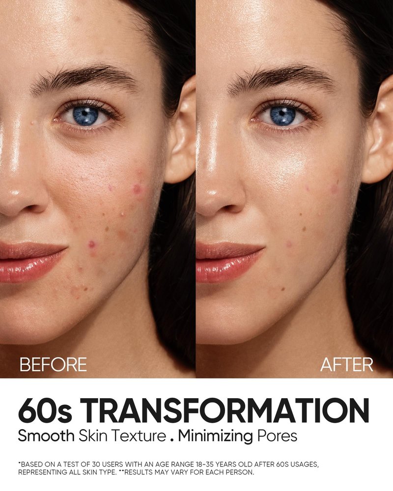 SKINTIFIC 12% AHA BHA PHA LHA Peeling Solution, Glycolic Acid Acne Treatment for Face, Exfoliating Peeling Serum for Dull, Rough, Oily Skin with Clogged Pores & Dead Cells